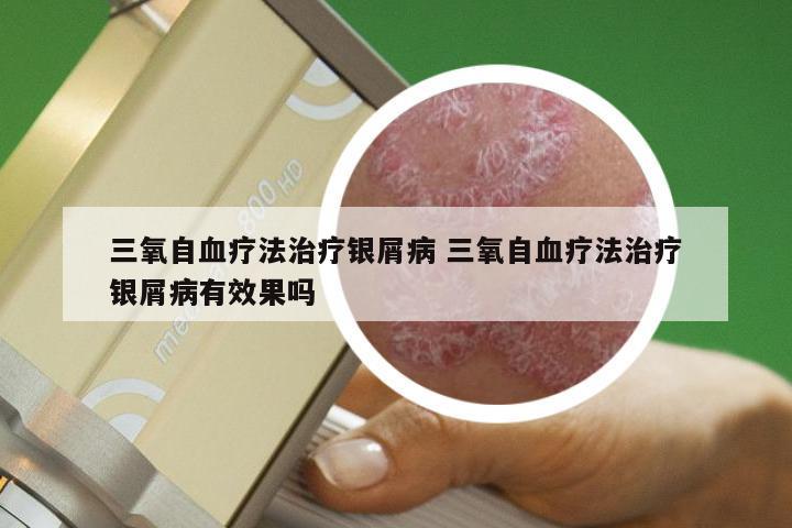 三氧自血疗法治疗银屑病 三氧自血疗法治疗银屑病有效果吗