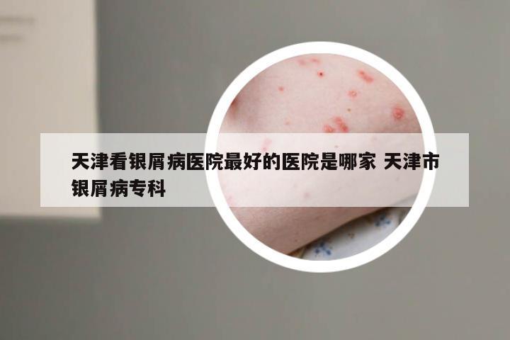 天津看银屑病医院最好的医院是哪家 天津市银屑病专科