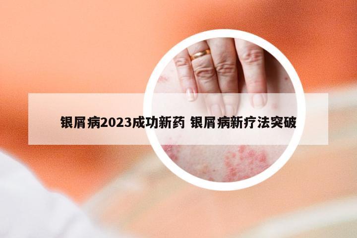 银屑病2023成功新药 银屑病新疗法突破