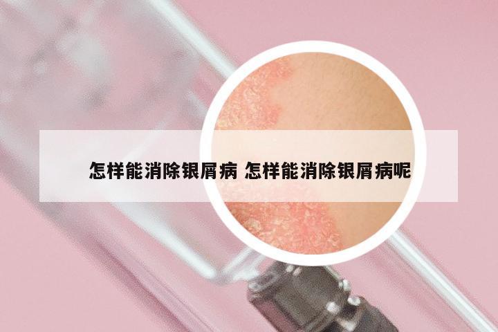 怎样能消除银屑病 怎样能消除银屑病呢