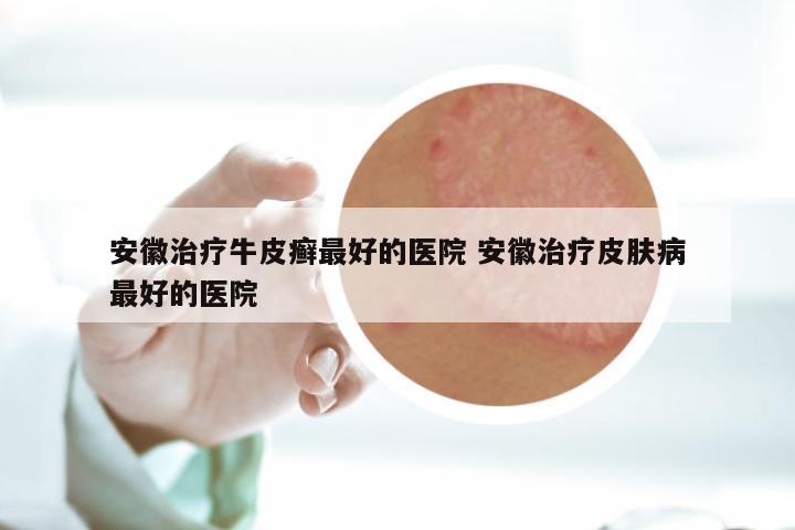 安徽治疗牛皮癣最好的医院 安徽治疗皮肤病最好的医院