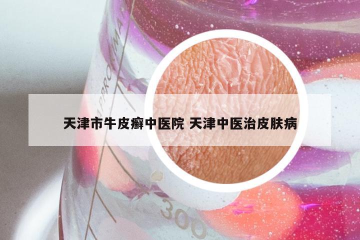 天津市牛皮癣中医院 天津中医治皮肤病