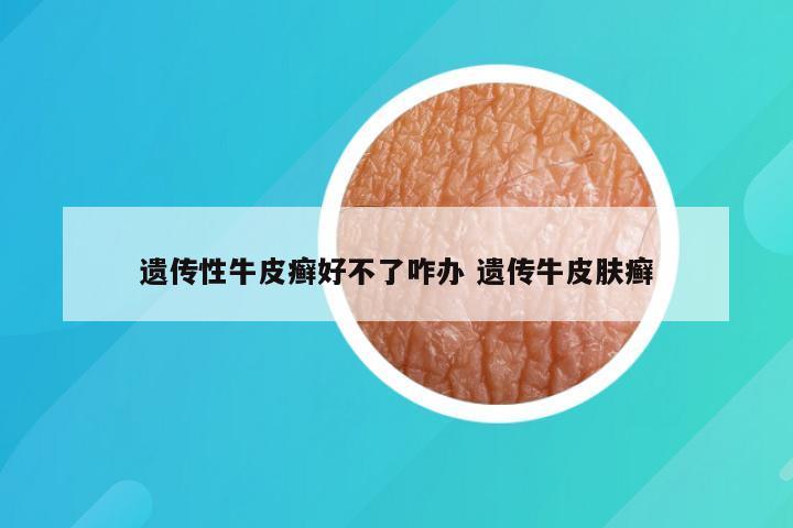 遗传性牛皮癣好不了咋办 遗传牛皮肤癣