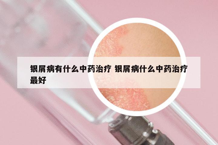 银屑病有什么中药治疗 银屑病什么中药治疗最好