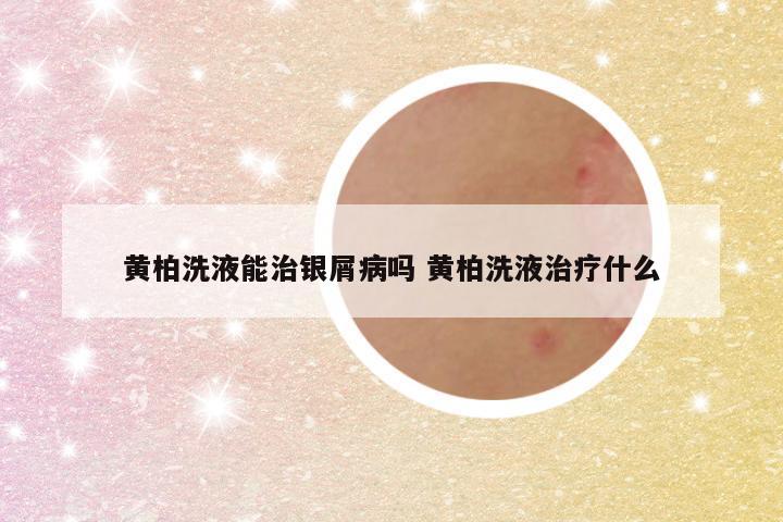 黄柏洗液能治银屑病吗 黄柏洗液治疗什么
