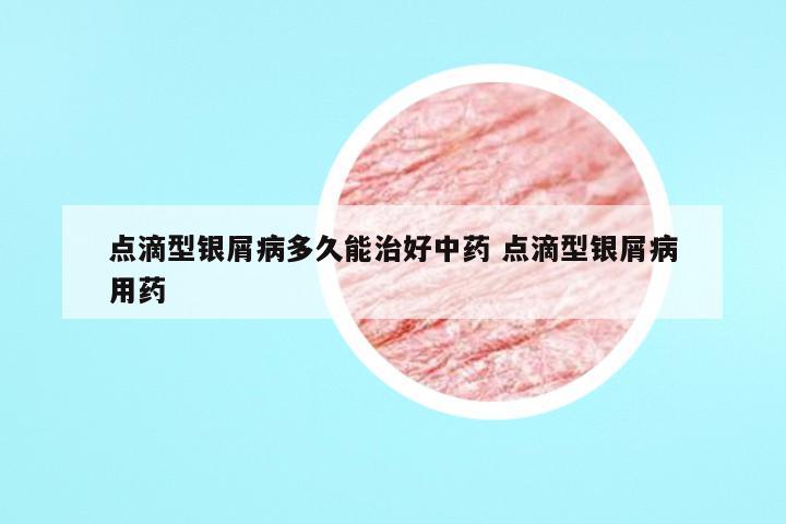 点滴型银屑病多久能治好中药 点滴型银屑病用药