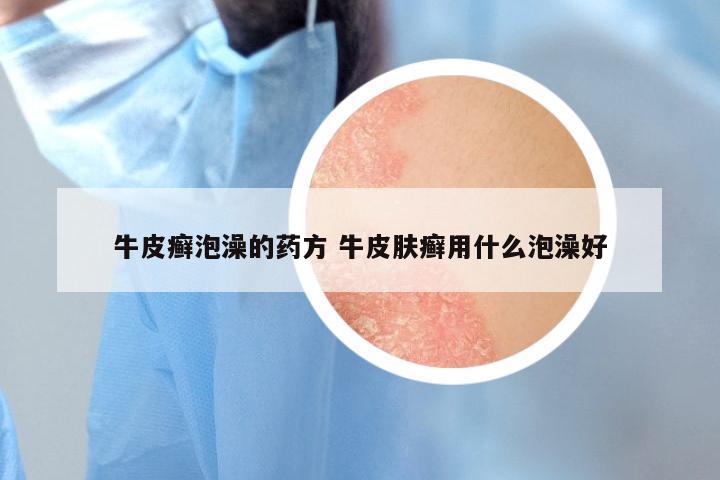 牛皮癣泡澡的药方 牛皮肤癣用什么泡澡好