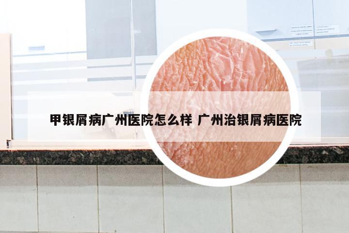 甲银屑病广州医院怎么样 广州治银屑病医院