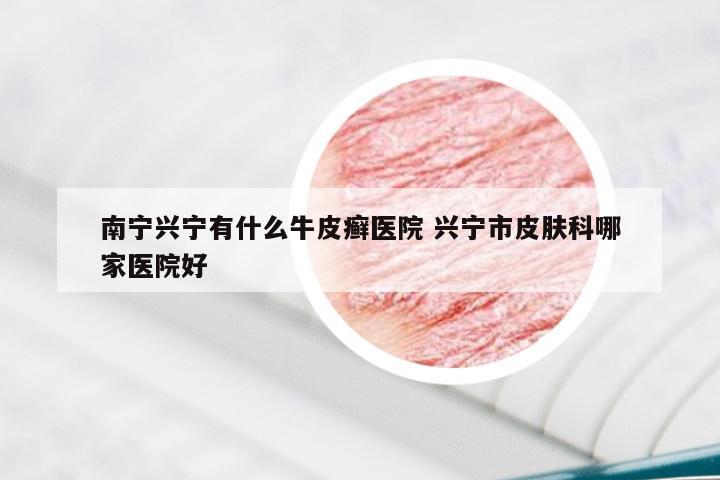 南宁兴宁有什么牛皮癣医院 兴宁市皮肤科哪家医院好