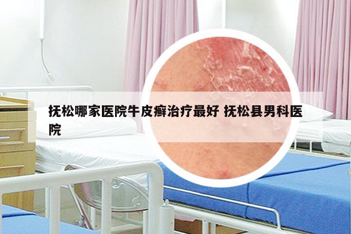 抚松哪家医院牛皮癣治疗最好 抚松县男科医院