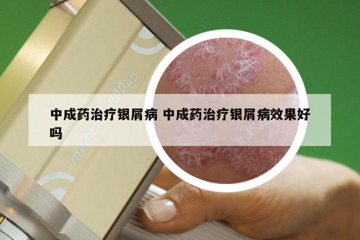 中成药治疗银屑病 中成药治疗银屑病效果好吗