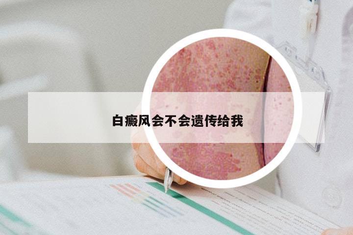 白癜风会不会遗传给我
