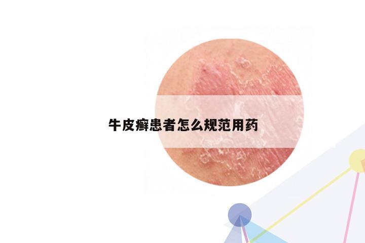 牛皮癣患者怎么规范用药