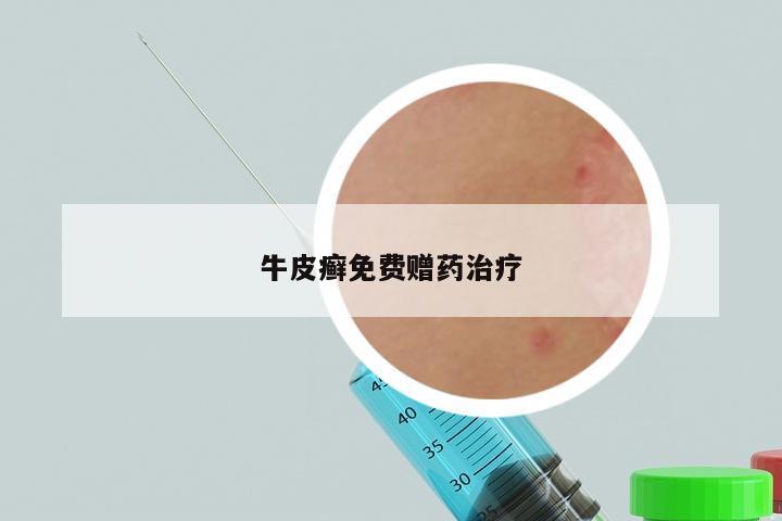 牛皮癣免费赠药治疗