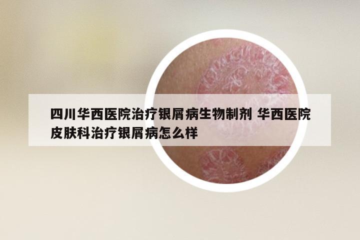 四川华西医院治疗银屑病生物制剂 华西医院皮肤科治疗银屑病怎么样