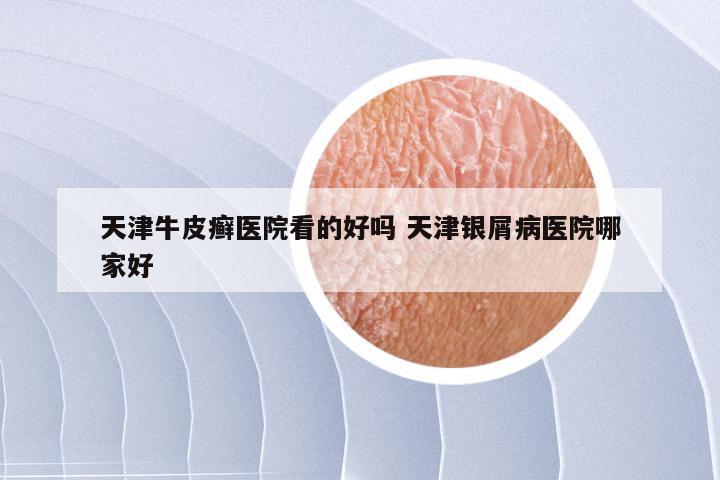 天津牛皮癣医院看的好吗 天津银屑病医院哪家好