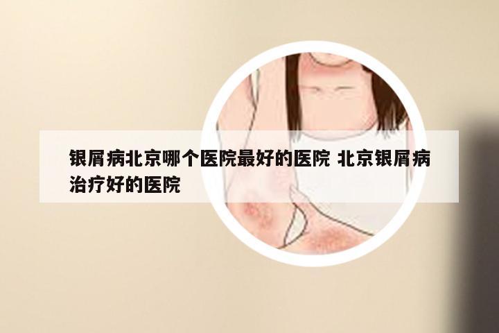 银屑病北京哪个医院最好的医院 北京银屑病治疗好的医院
