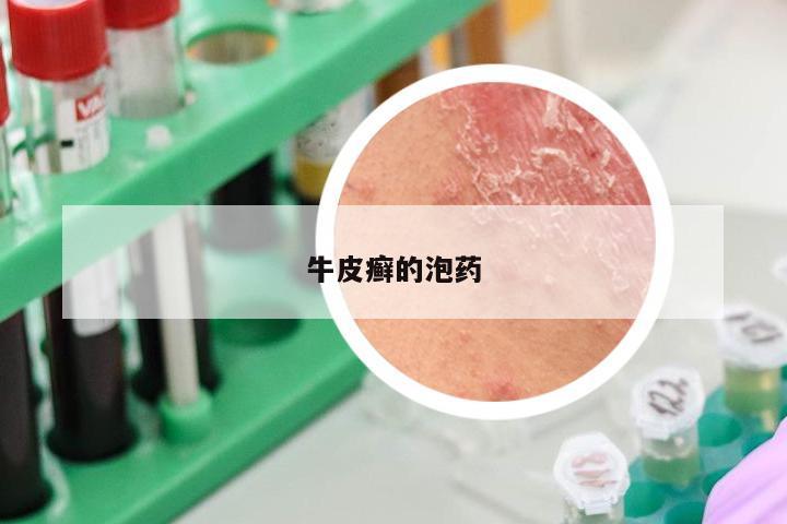 牛皮癣的泡药