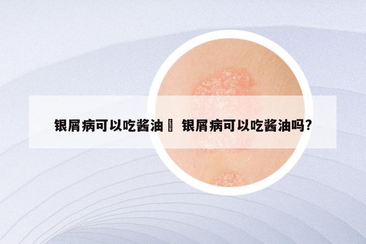 银屑病可以吃酱油碏 银屑病可以吃酱油吗?