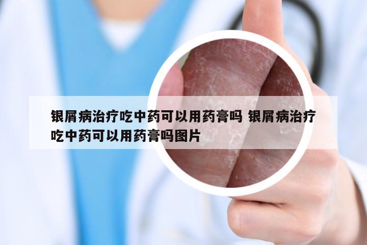 银屑病治疗吃中药可以用药膏吗 银屑病治疗吃中药可以用药膏吗图片