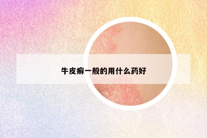 牛皮癣一般的用什么药好