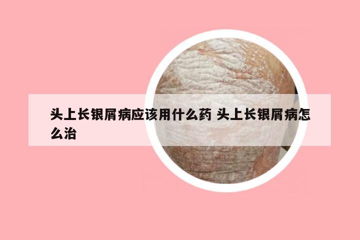 头上长银屑病应该用什么药 头上长银屑病怎么治