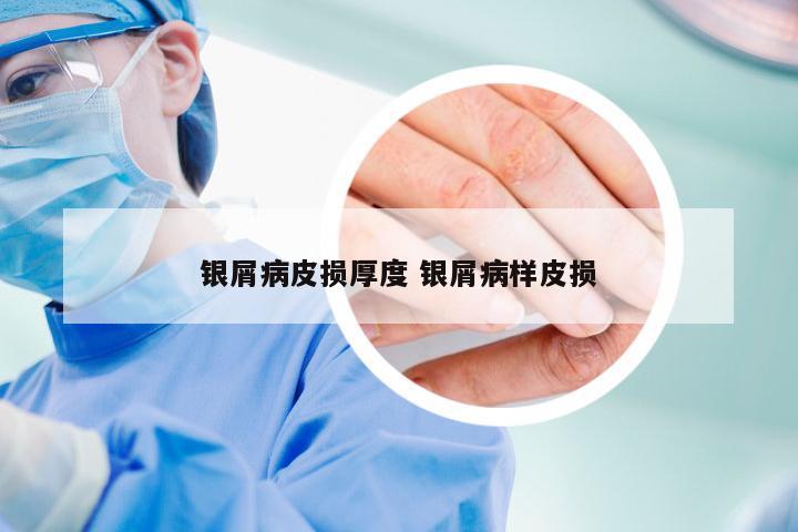 银屑病皮损厚度 银屑病样皮损