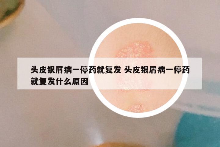 头皮银屑病一停药就复发 头皮银屑病一停药就复发什么原因
