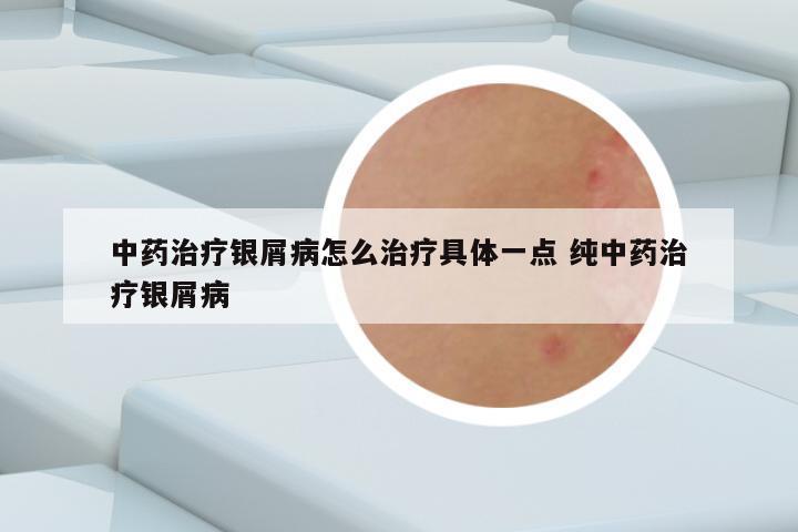 中药治疗银屑病怎么治疗具体一点 纯中药治疗银屑病