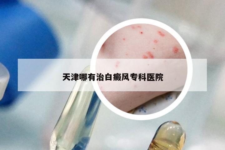 天津哪有治白癜风专科医院