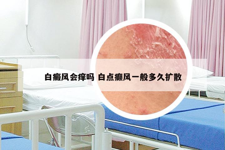 白癜风会痒吗 白点癫风一般多久扩散
