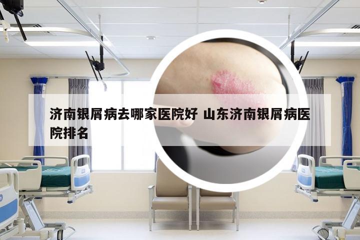 济南银屑病去哪家医院好 山东济南银屑病医院排名