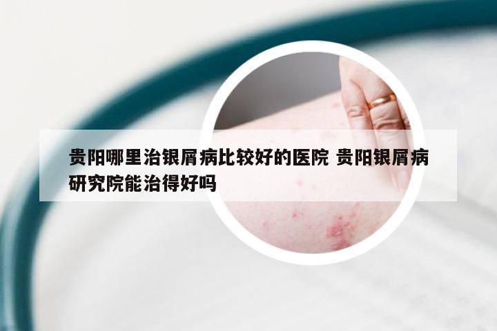 贵阳哪里治银屑病比较好的医院 贵阳银屑病研究院能治得好吗