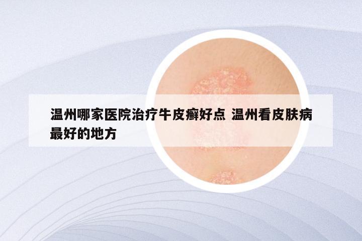 温州哪家医院治疗牛皮癣好点 温州看皮肤病最好的地方