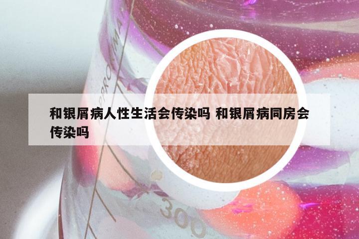 和银屑病人性生活会传染吗 和银屑病同房会传染吗