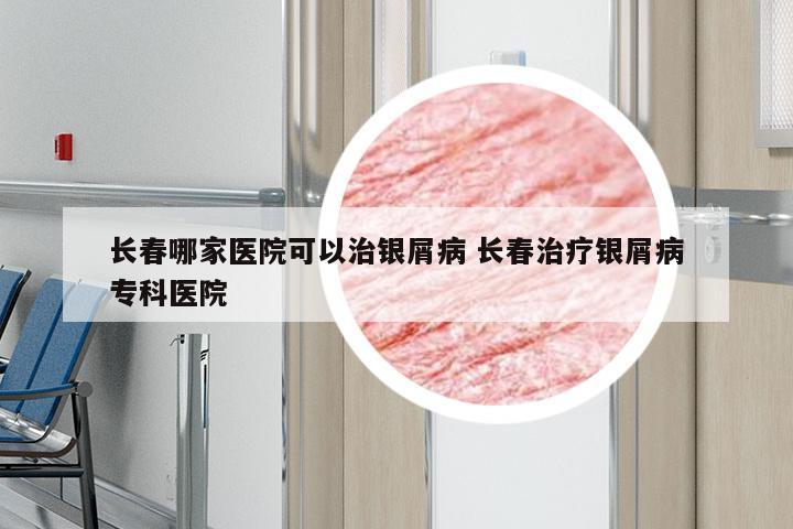 长春哪家医院可以治银屑病 长春治疗银屑病专科医院