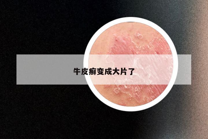牛皮癣变成大片了