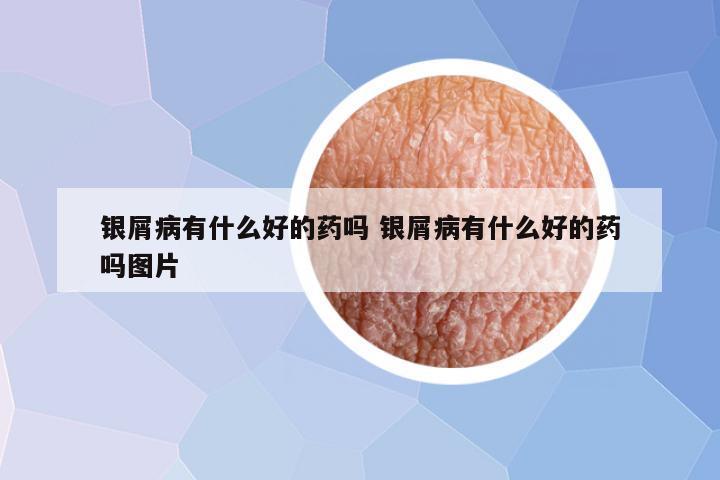 银屑病有什么好的药吗 银屑病有什么好的药吗图片