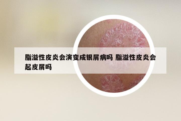 脂溢性皮炎会演变成银屑病吗 脂溢性皮炎会起皮屑吗