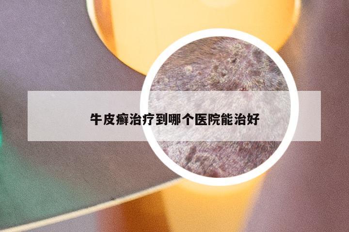 牛皮癣治疗到哪个医院能治好