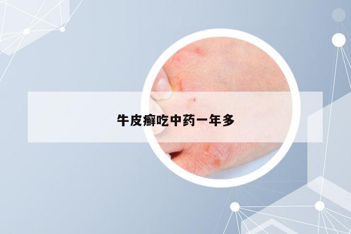 牛皮癣吃中药一年多