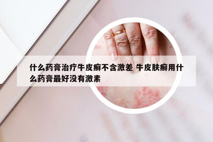 什么药膏治疗牛皮癣不含激差 牛皮肤癣用什么药膏最好没有激素