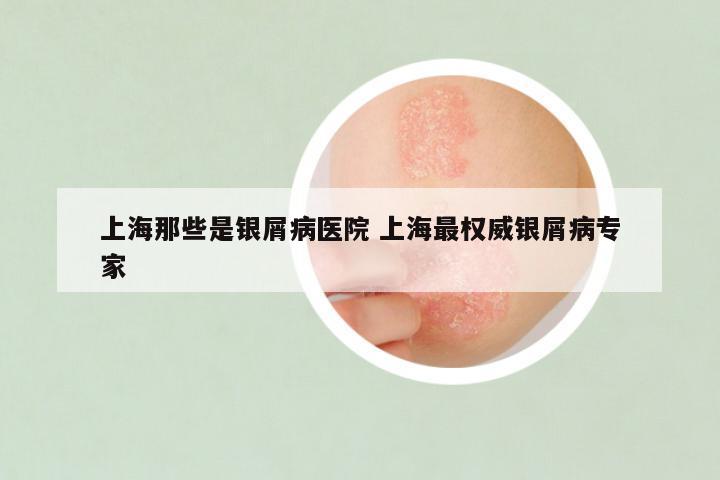 上海那些是银屑病医院 上海最权威银屑病专家