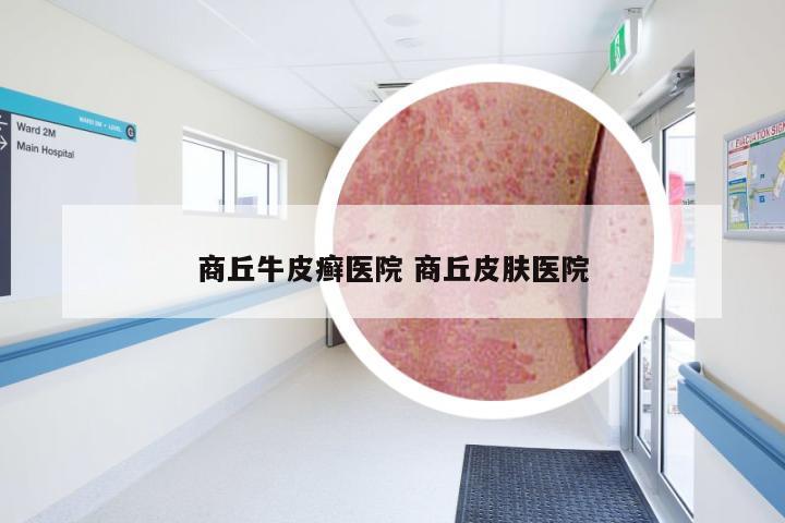 商丘牛皮癣医院 商丘皮肤医院