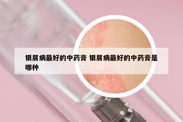 银屑病最好的中药膏 银屑病最好的中药膏是哪种