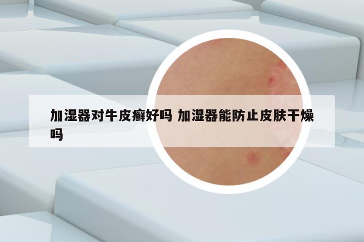 加湿器对牛皮癣好吗 加湿器能防止皮肤干燥吗