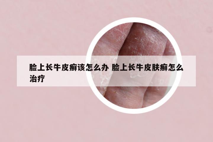 脸上长牛皮癣该怎么办 脸上长牛皮肤癣怎么治疗