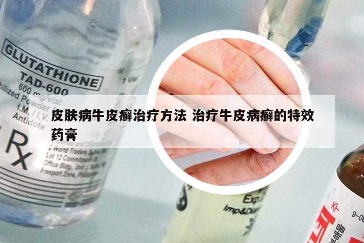 皮肤病牛皮癣治疗方法 治疗牛皮病癣的特效药膏