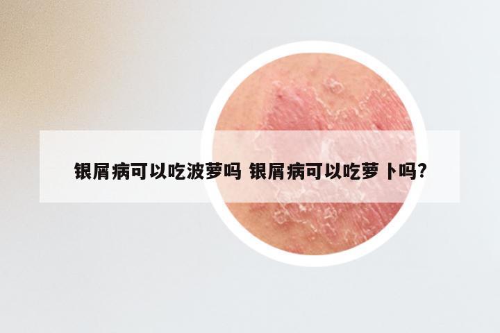 银屑病可以吃波萝吗 银屑病可以吃萝卜吗?