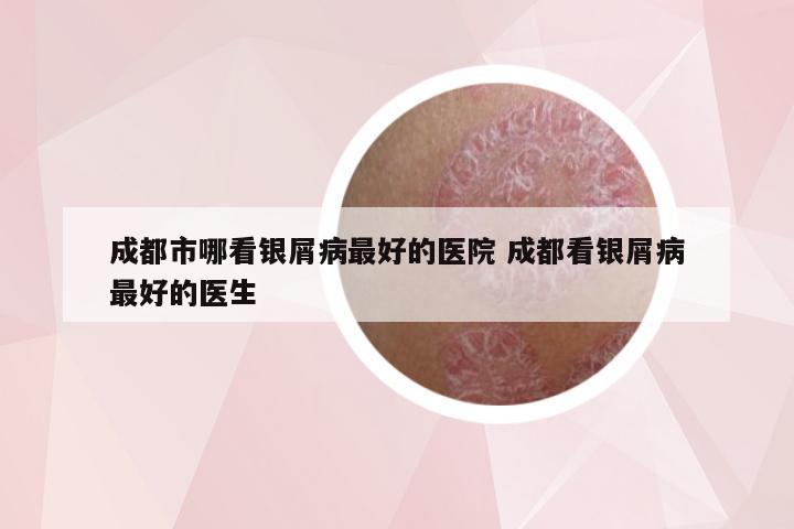 成都市哪看银屑病最好的医院 成都看银屑病最好的医生